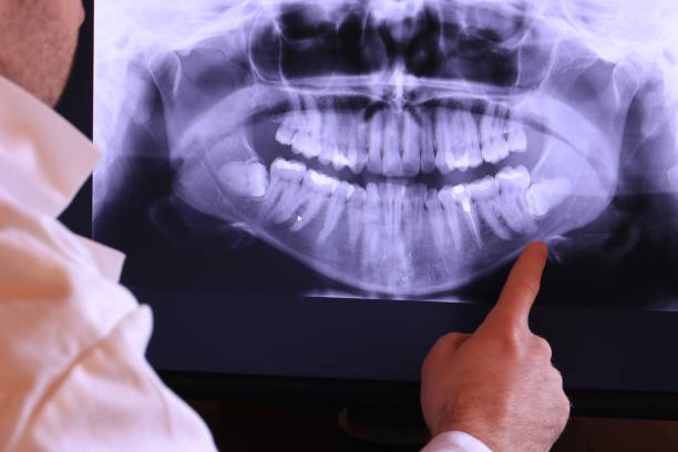 Best Emergency Wisdom Teeth Removal in Oviedo, FL